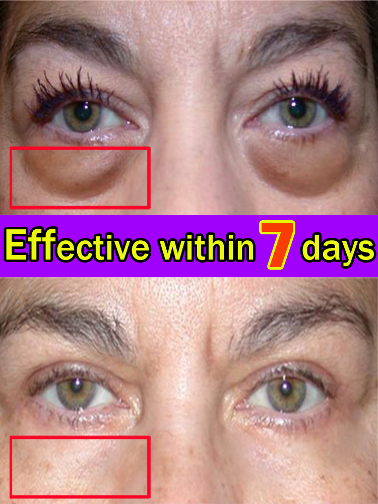 Best of Eye Cream Puffiness Away Work Under Eyes Reduce Bags Reviews & Tips