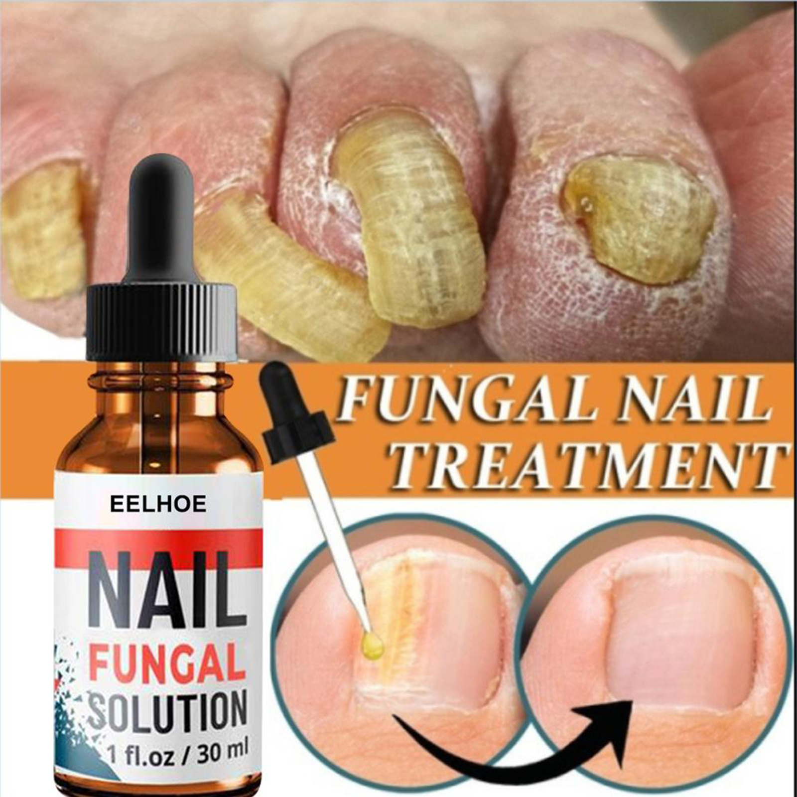 2x Fungal Nail Eraser Treatment Essence Repair Brittle Nail Onychomycosis
