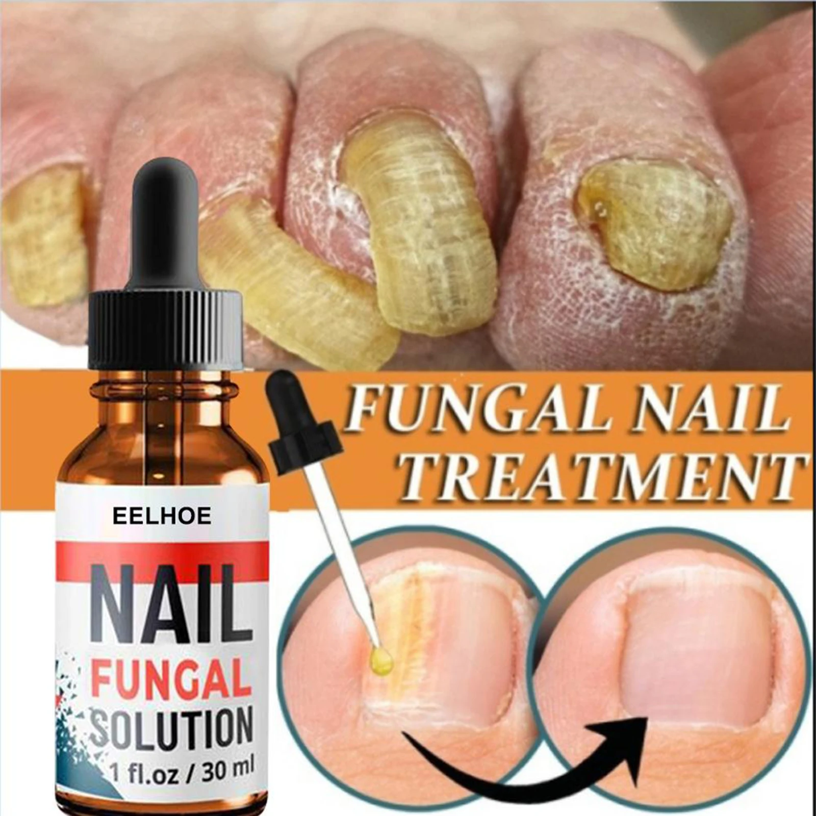 Fungal Nail Toenail Treatment Eczema Nail Relief Maximum Strength Clear Nails Repair Damaged Brittle Nail  Onychomycosis