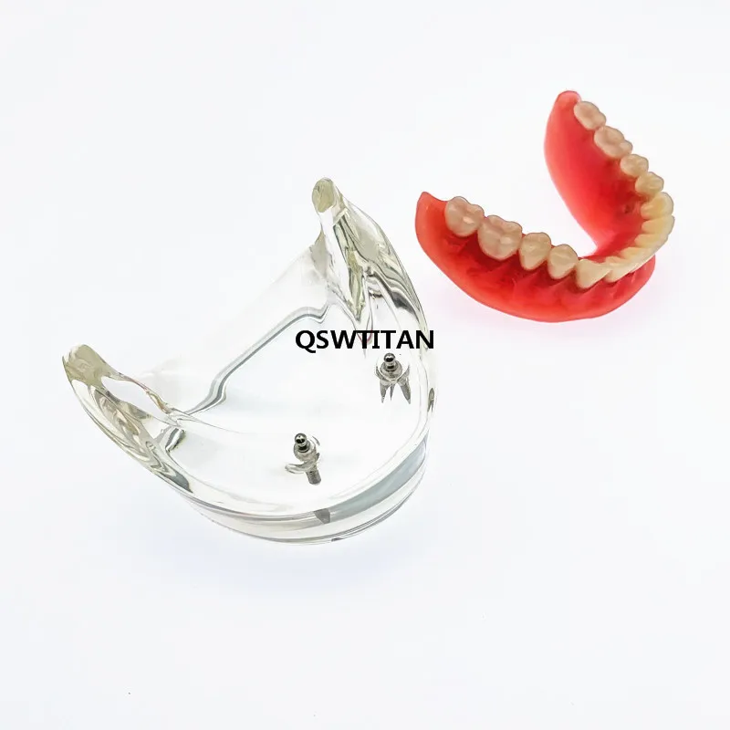 modèle de prothèse mandibulaire interne amovible avec implant pour de des dents