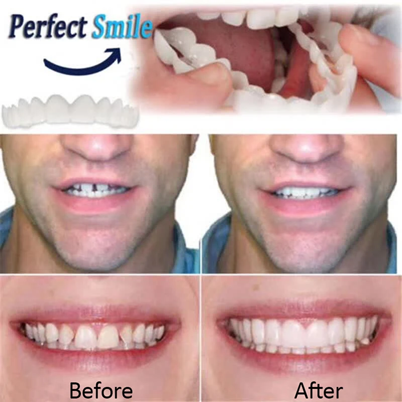 Instant Smi-le  Cosmetic Teeth, Natural Bright White Shade, Comfortable Upper and Lower Veneer