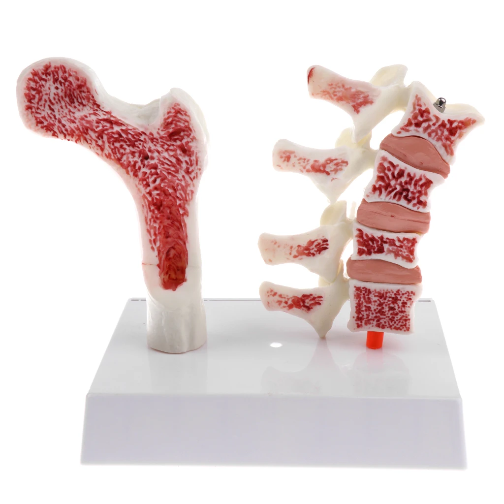 1:1 Human Medical Lumbar Vertebra Thighbone Osteoporosis Pathology Model Kit