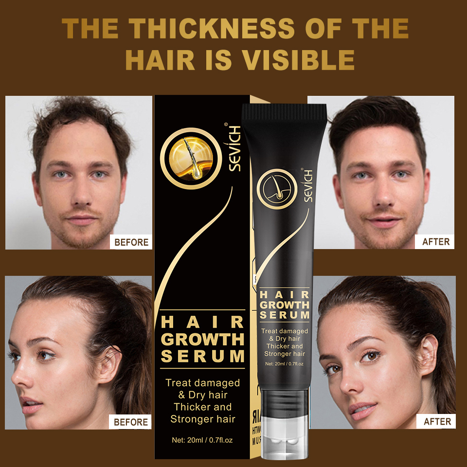 Best of Sevich Hair Growth Oil Ginger Extract Growing Serum Prevent Hair Loss Care Scalp Massage Roller Treatment Thickener Essence 20ml Reviews & Tips - Image 2