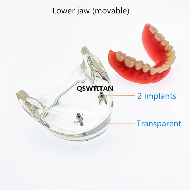 removível interior com 2 implantes para ensino de dentes e estudo