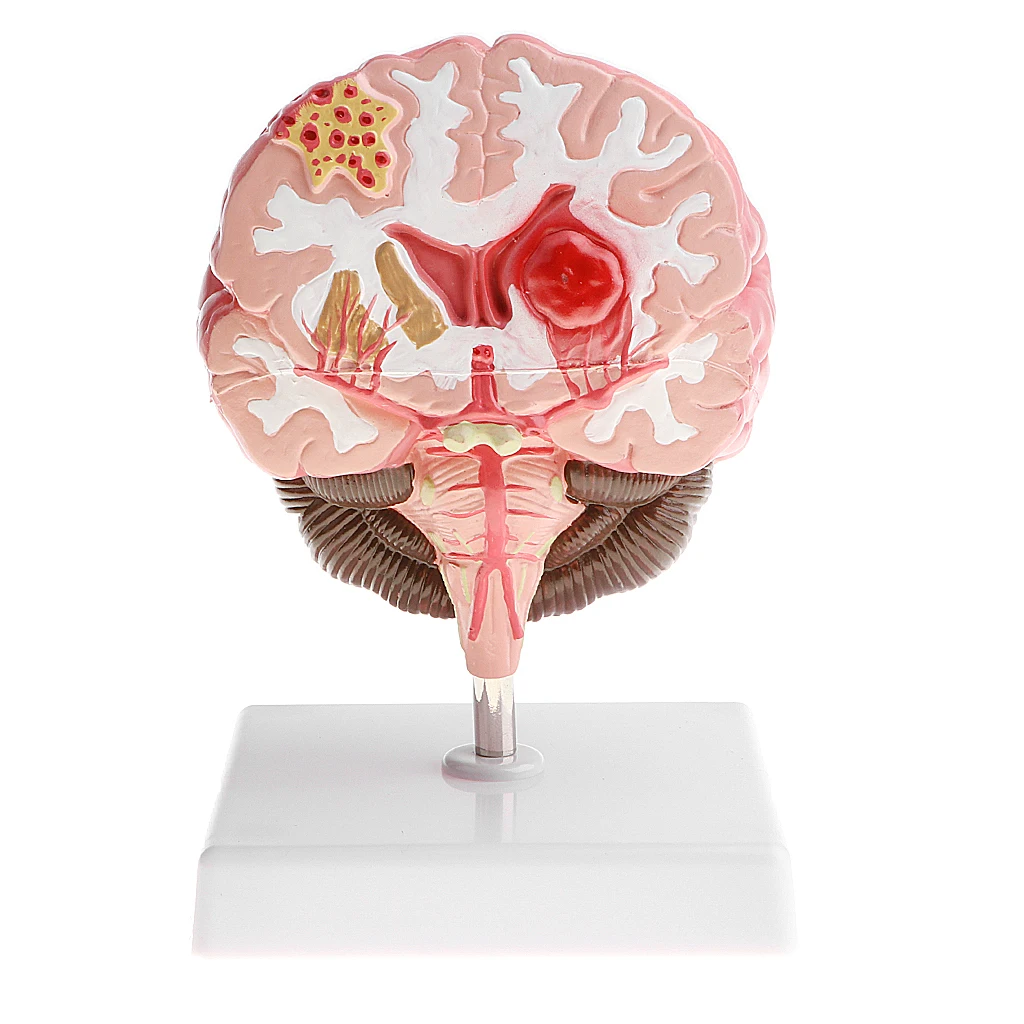 anatomia do cérebro humano doença patológica modelo médico ferramenta de ensino laboratório exibição modelo escola educacional cérebro modelo