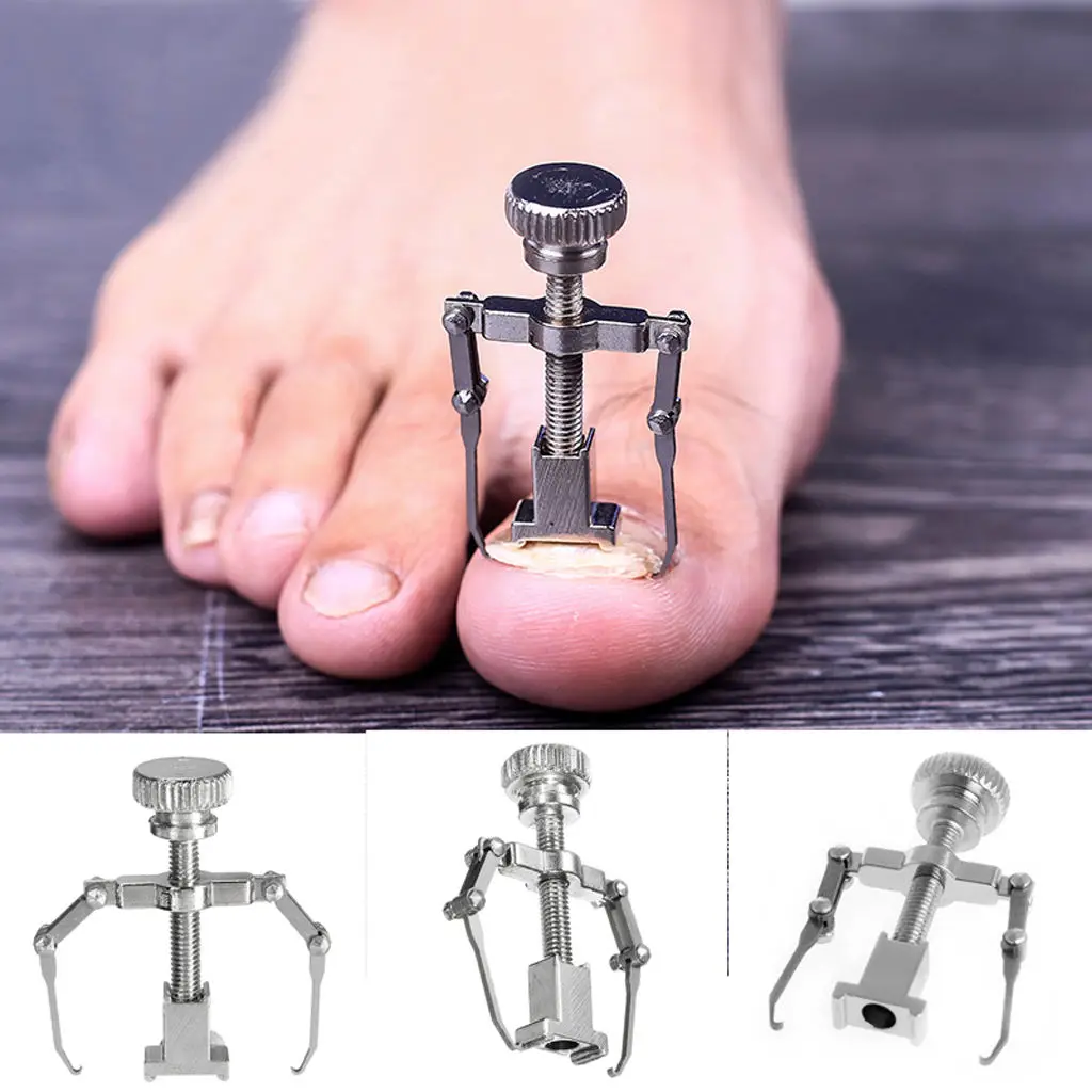 Ingrown Toe Nail Recover Correction Fixer Pedicure Tool Foot Nail Orthotic Lever Mechanics To Change The Angle Of Nail Growth
