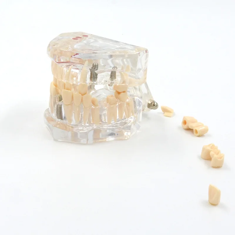 Modelo dentário de reparação patológica transparente, modelo dentário humano