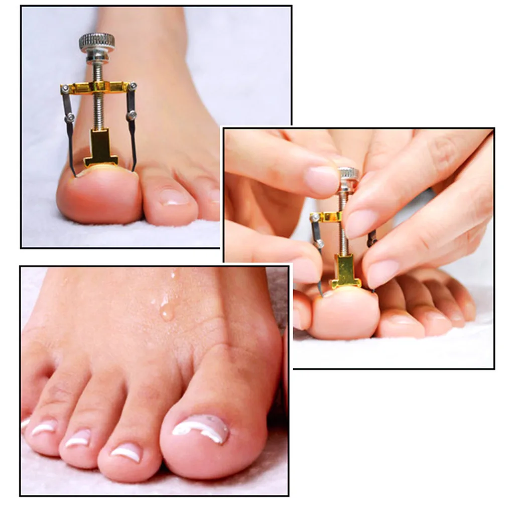 Pro Ingrown Toe foot Nail Correction Fixer Toenail Corrector Pedicure Set