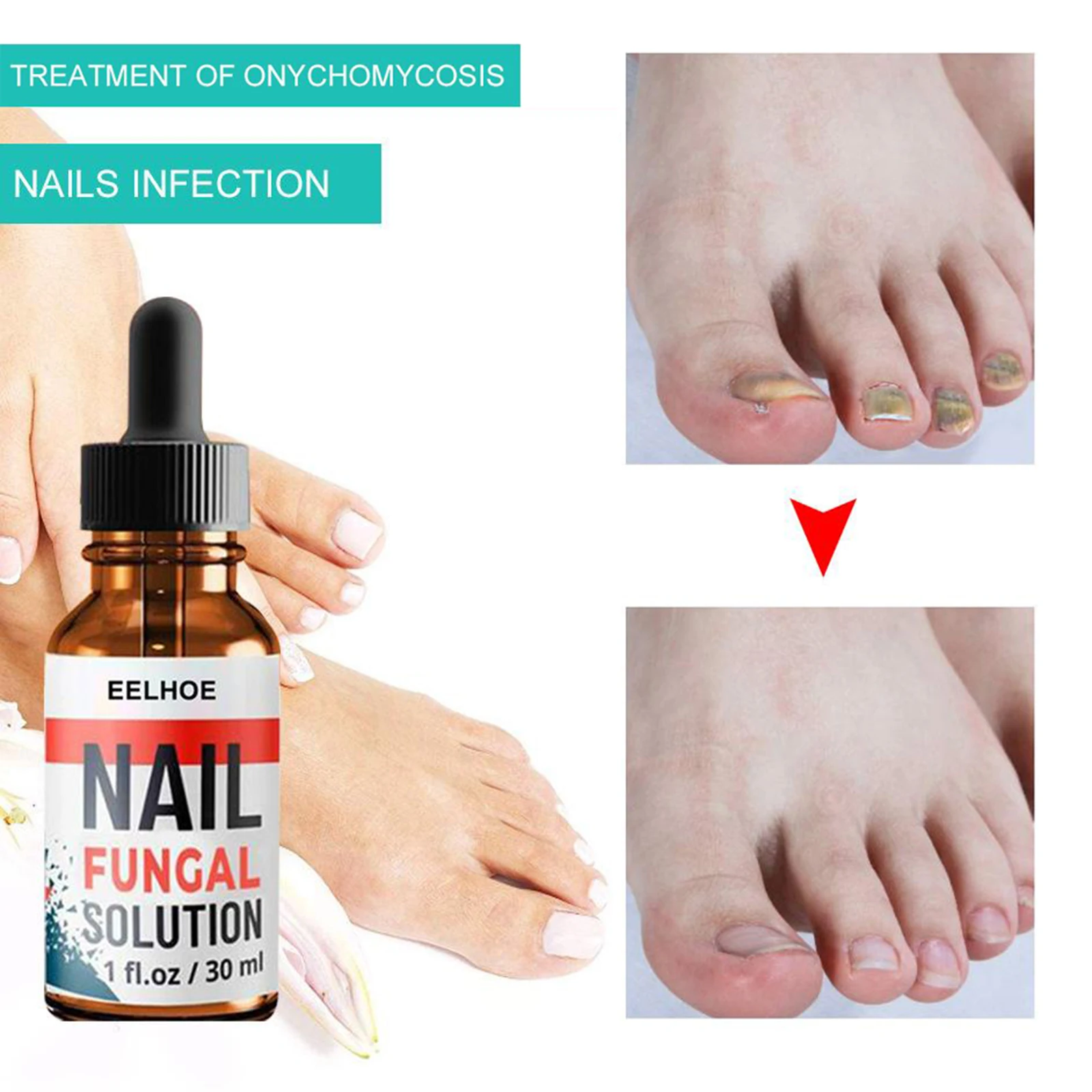 2x Fungal Nail Eraser Treatment Essence Repair Brittle Nail Onychomycosis