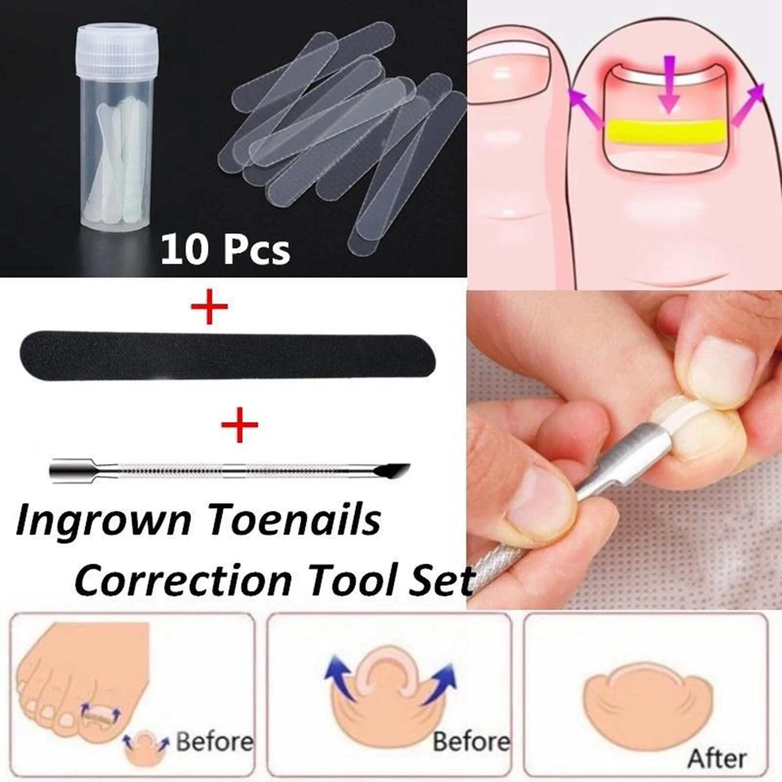 Ingrown Toenail Straightening Clip Brace Foot Care Nails Patch Correction