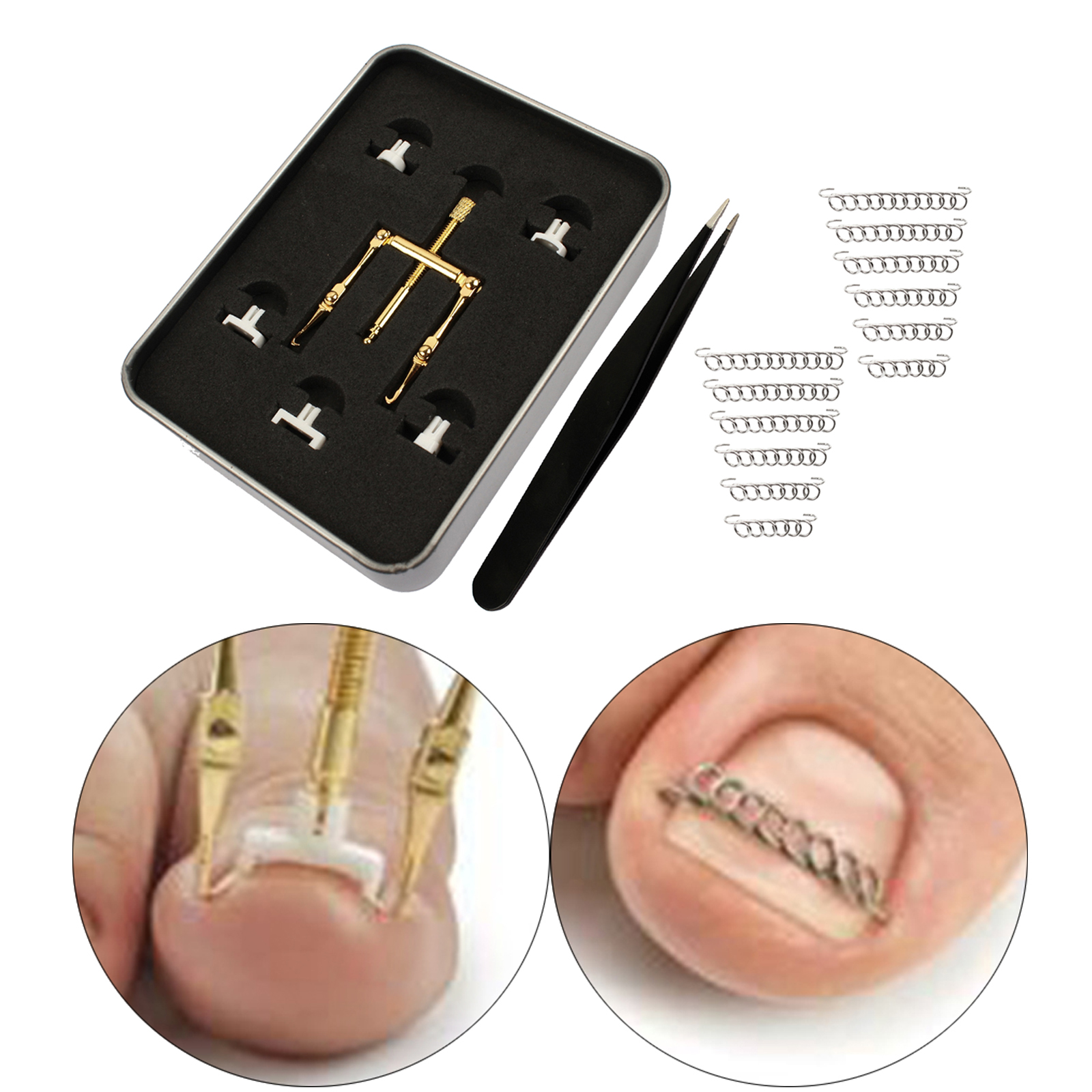 Professional Ingrown Toenail Correction Straightening Clip Fixer Recover Toe Nail Lifter Clamp Tweezer Wire Foot Pedicure Tool