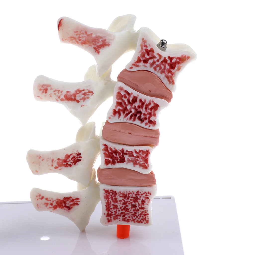 1:1 Human Medical Lumbar Vertebra Thighbone Osteoporosis Pathology Model Kit