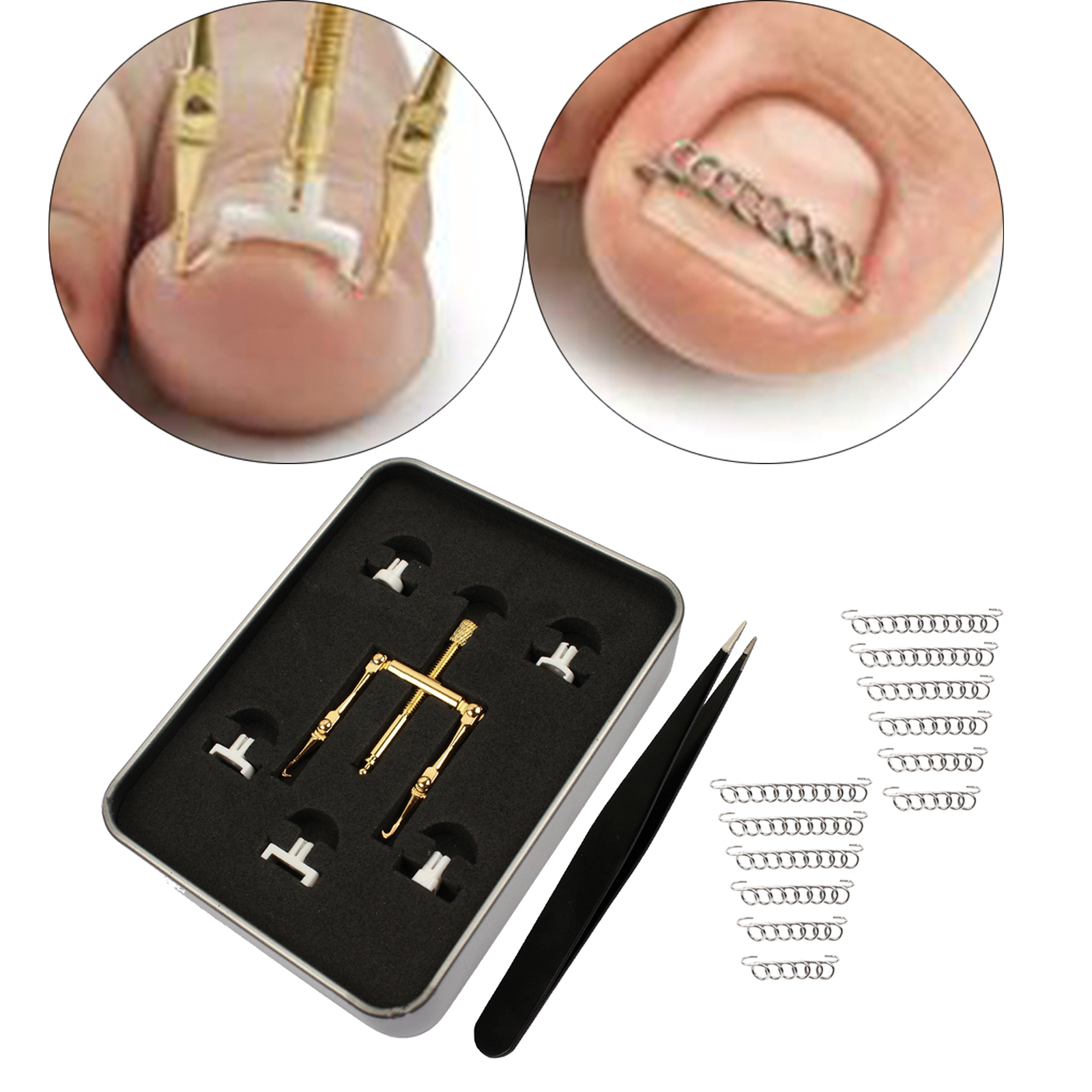 Ingrown Toenail Treatment Kit Corrector Fixer Recover Toe Nail Lifter Clamp Tweezer Wire Foot Pedicure Tool for Paronychia