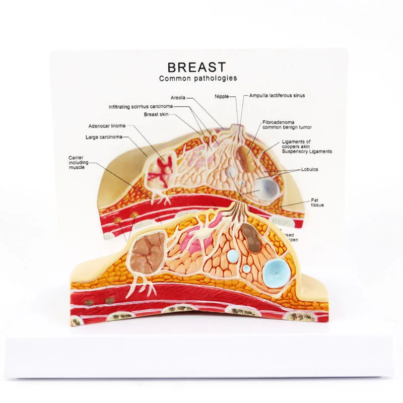 Breast Pathology Anatomy Model Kit