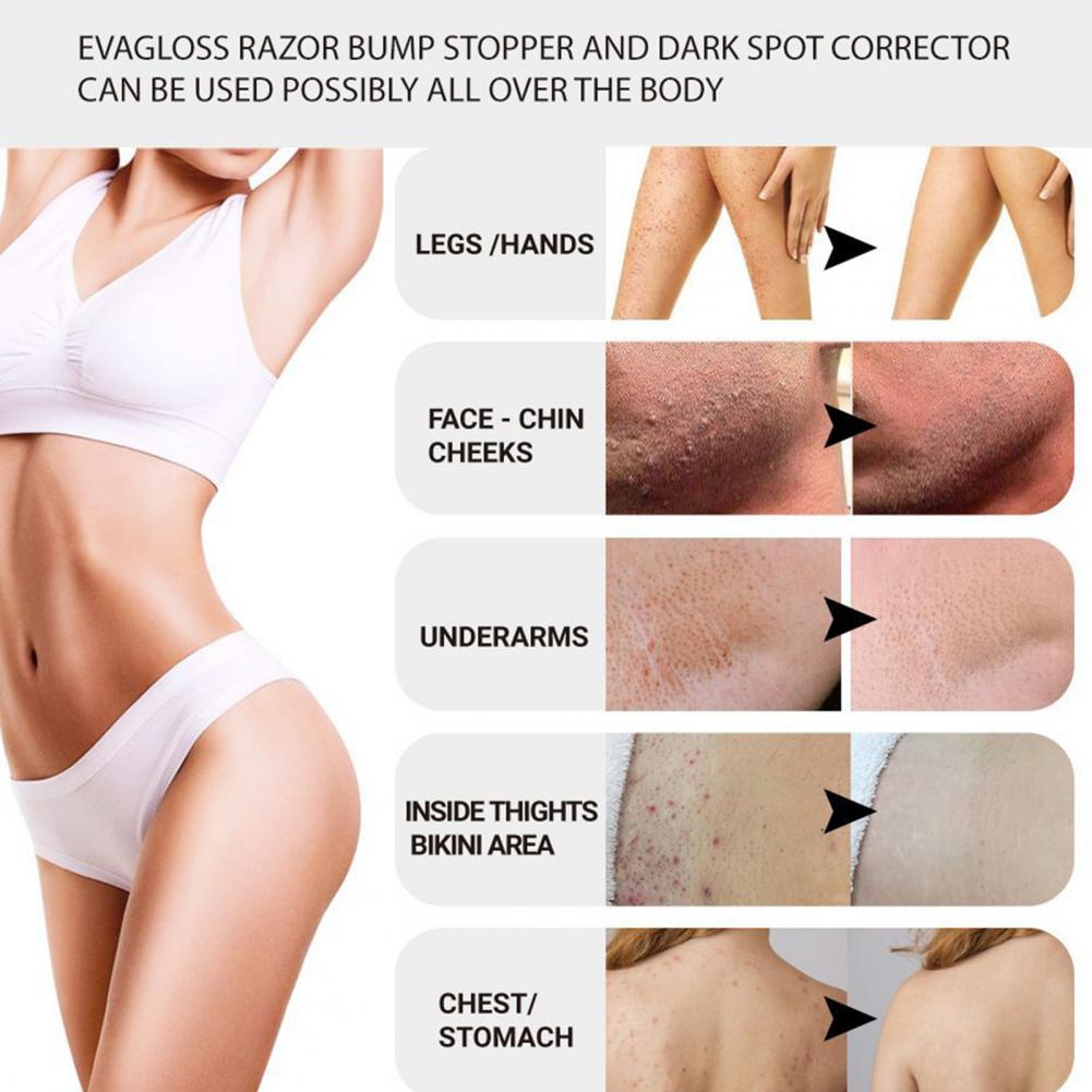 bikini bumps and dark spots