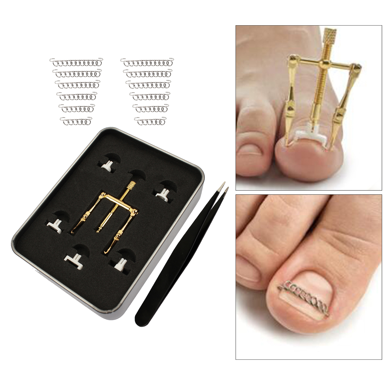 Ingrown Toenail Treatment Kit Corrector Fixer Recover Toe Nail Lifter Clamp Tweezer Wire Foot Pedicure Tool for Paronychia