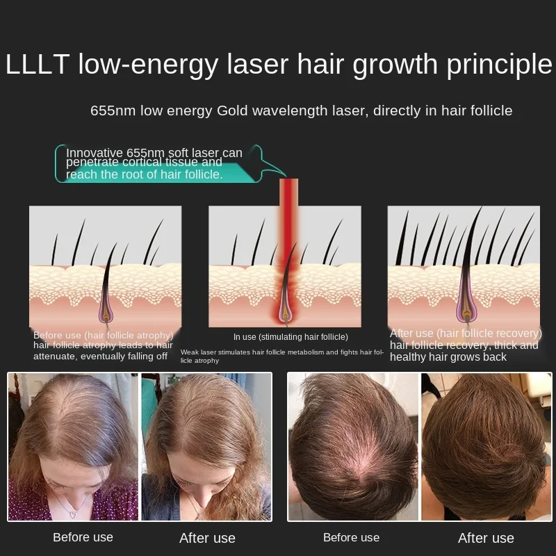 Laser Hair Generator Hair Growth Cap Helmet Anti Hair Loss Bald Hair Growth  Dense Hair Oil Removing Red Light Massage|Sản phẩm làm thon gọn| -  AliExpress