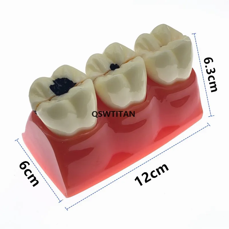 modelos de caries modelo de dentes para mostrar progresso de modelo de pesquisa para ensino de fistula