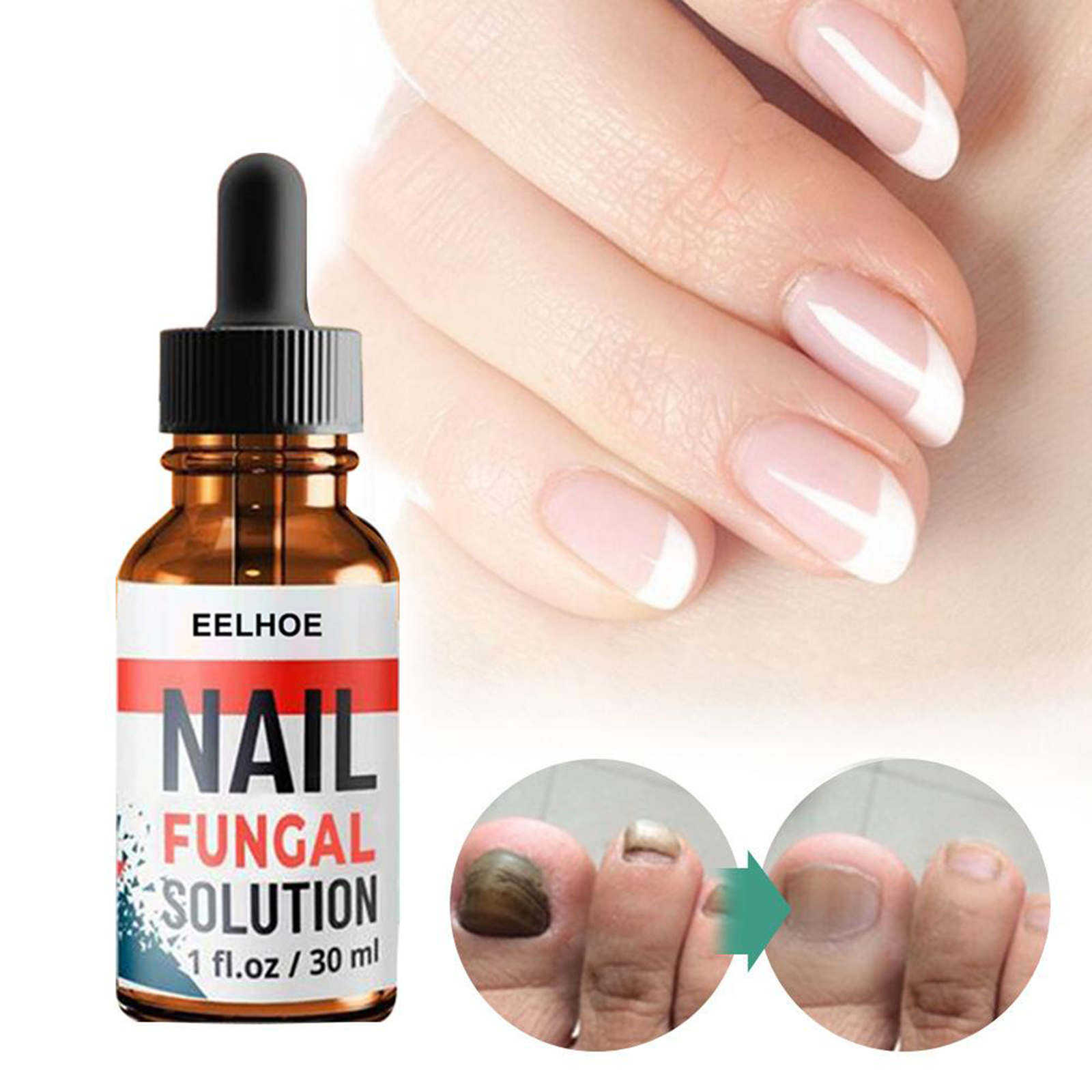 2x Fungal Nail Eraser Treatment Essence Repair Brittle Nail Onychomycosis