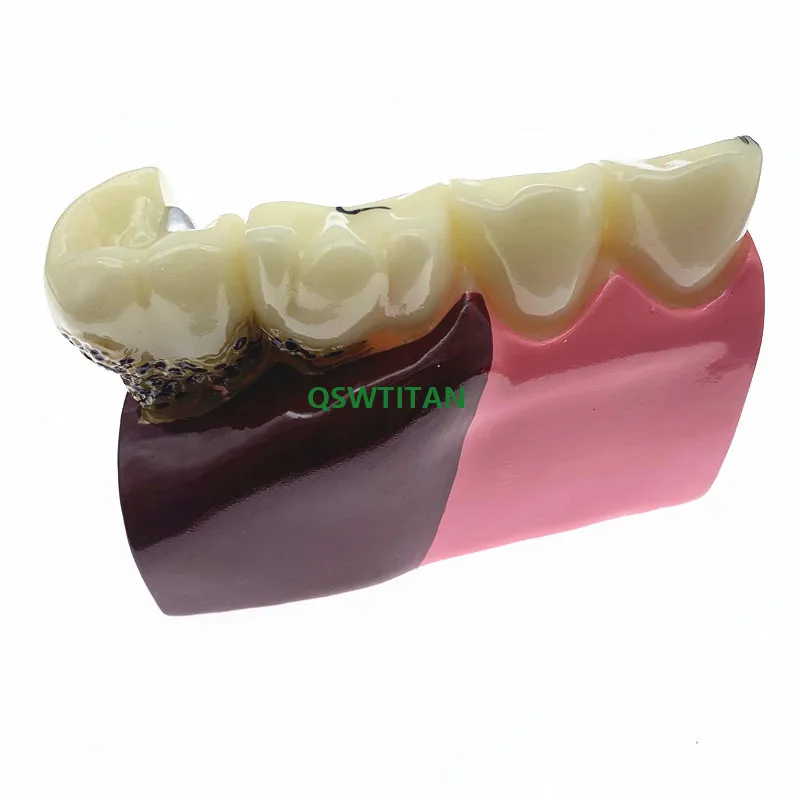 Anatomia dental de caries dentais modelo de