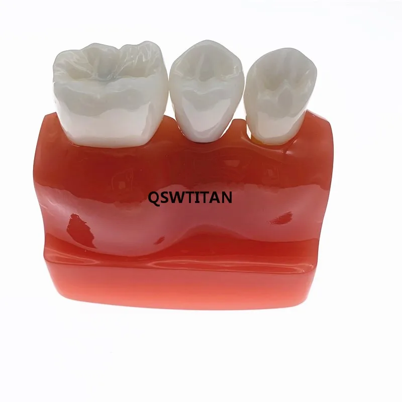 crown bridge modelo removível dentes de estudo dental modelo