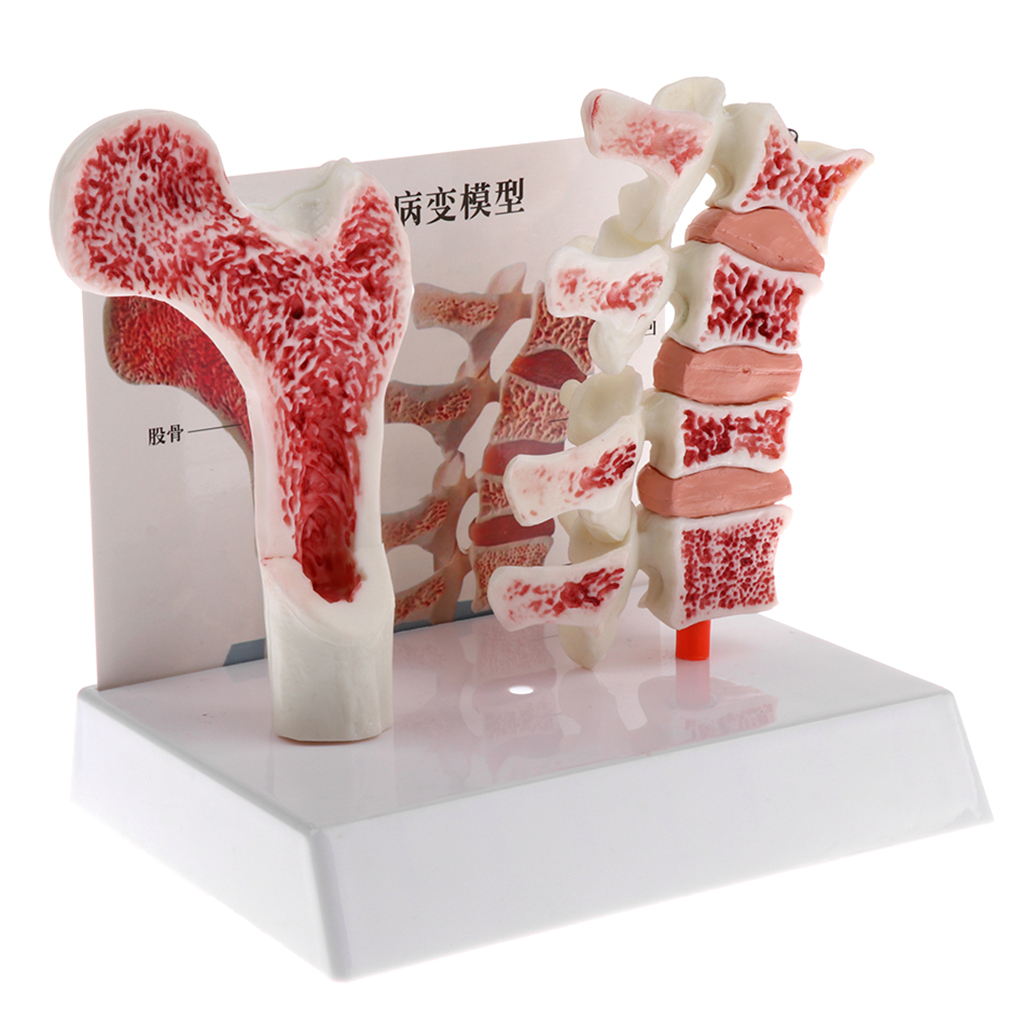 1:1 Human Medical Lumbar Vertebra Thighbone Osteoporosis Pathology Model Kit