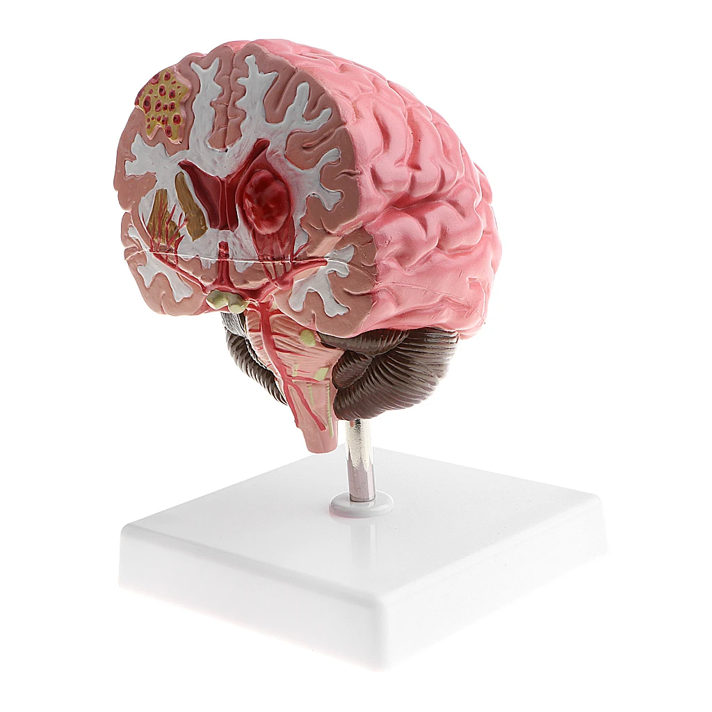 Anatomia do cérebro humano doença patológica modelo
