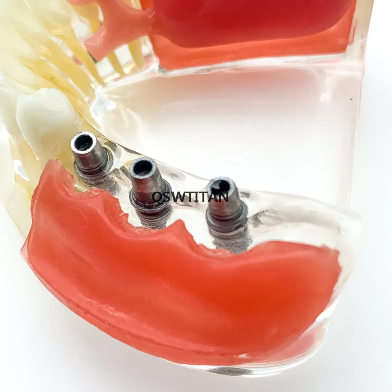 Modelo de implante dentário com restauração, modelo