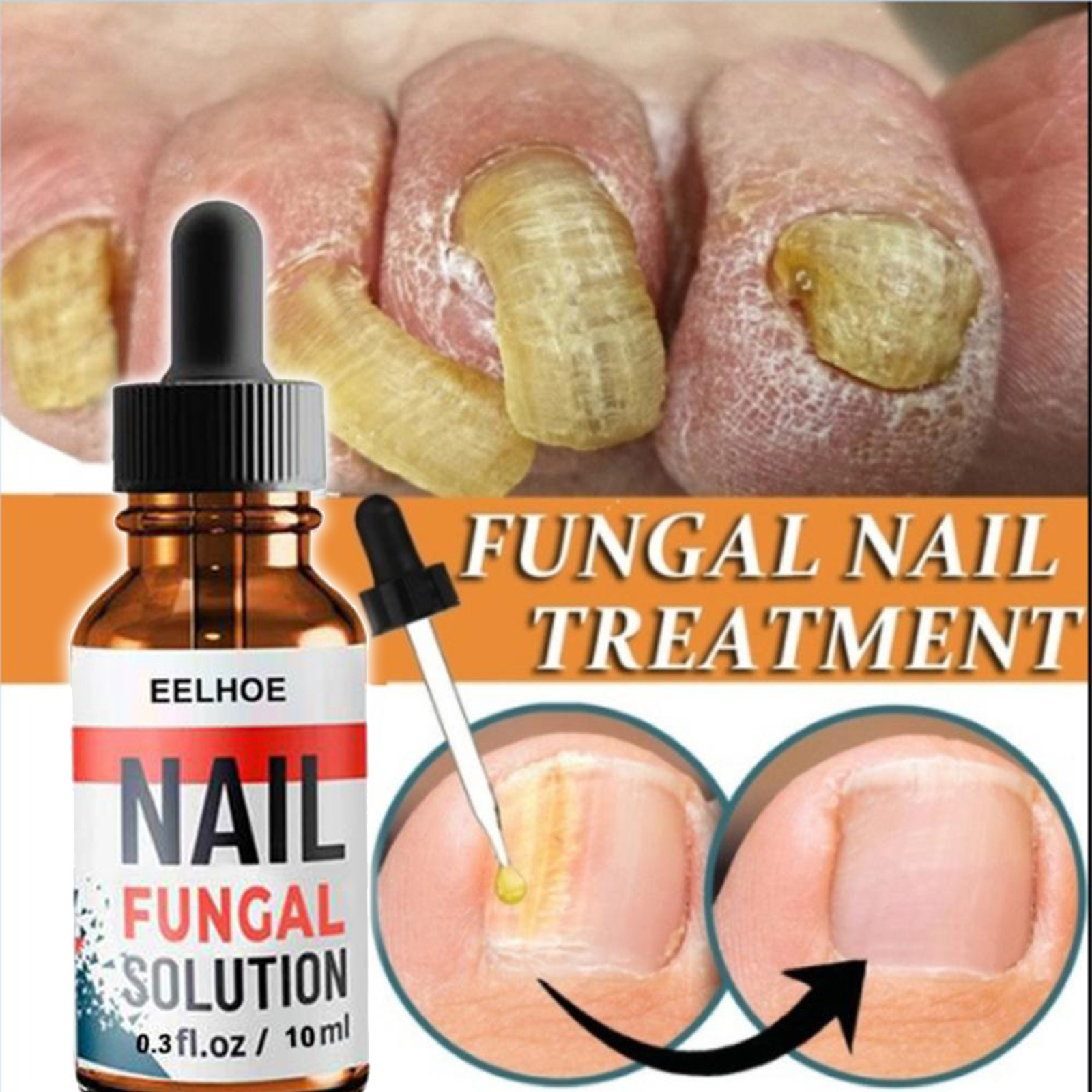 Fungal Nail Eraser Toenail Treatment Eczema Nail Relief Against Nail Infection Repair Nail Paronychia