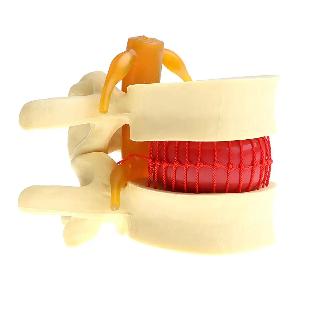  Human Spine  Vertebrae Degenerative  Disc Herniation Demonstration Model,  Teaching Tools, Magnified 2 Times