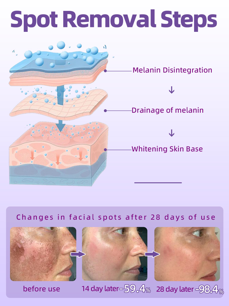 Best of Freckles Removal Melasma Cream Dark Spot Remover For Face Reviews & Tips - Image 5