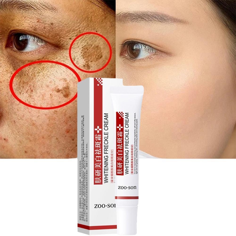 Best of Whitening Freckle Cream Remove Dark Spots Anti Freckle Face Creams Niacinamide Fade Pigmentation Melasma Brighten Skin Care 20g Reviews & Tips