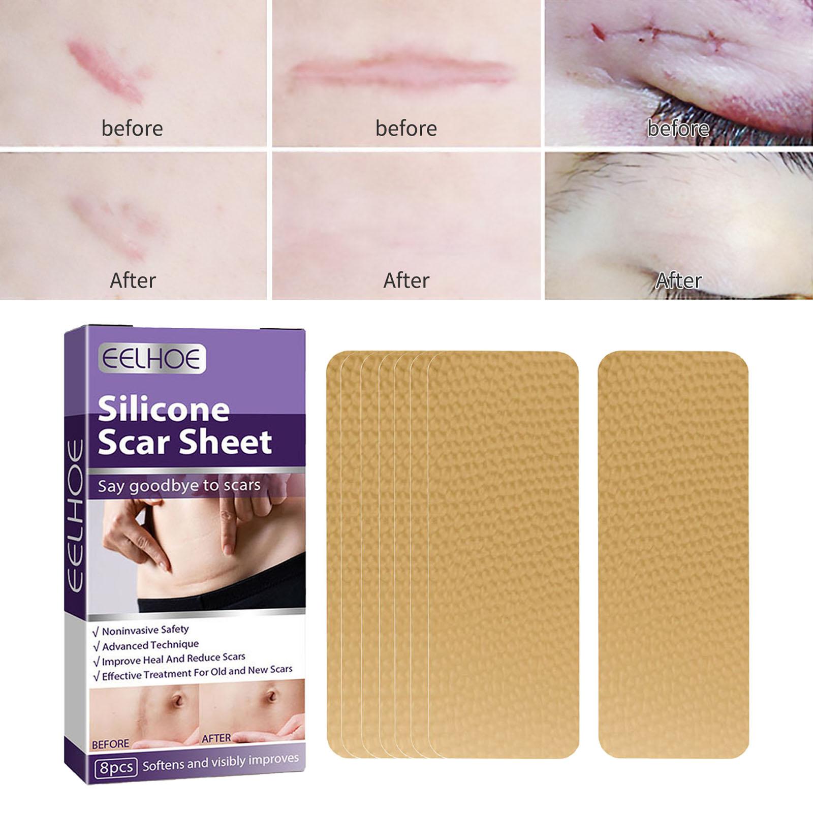 Scar Removal Silicone Scar Strips, for Burn Scars Acne Scars Keloid Scars Soft Scar Patch Comfortable Stretch Mark Reducer