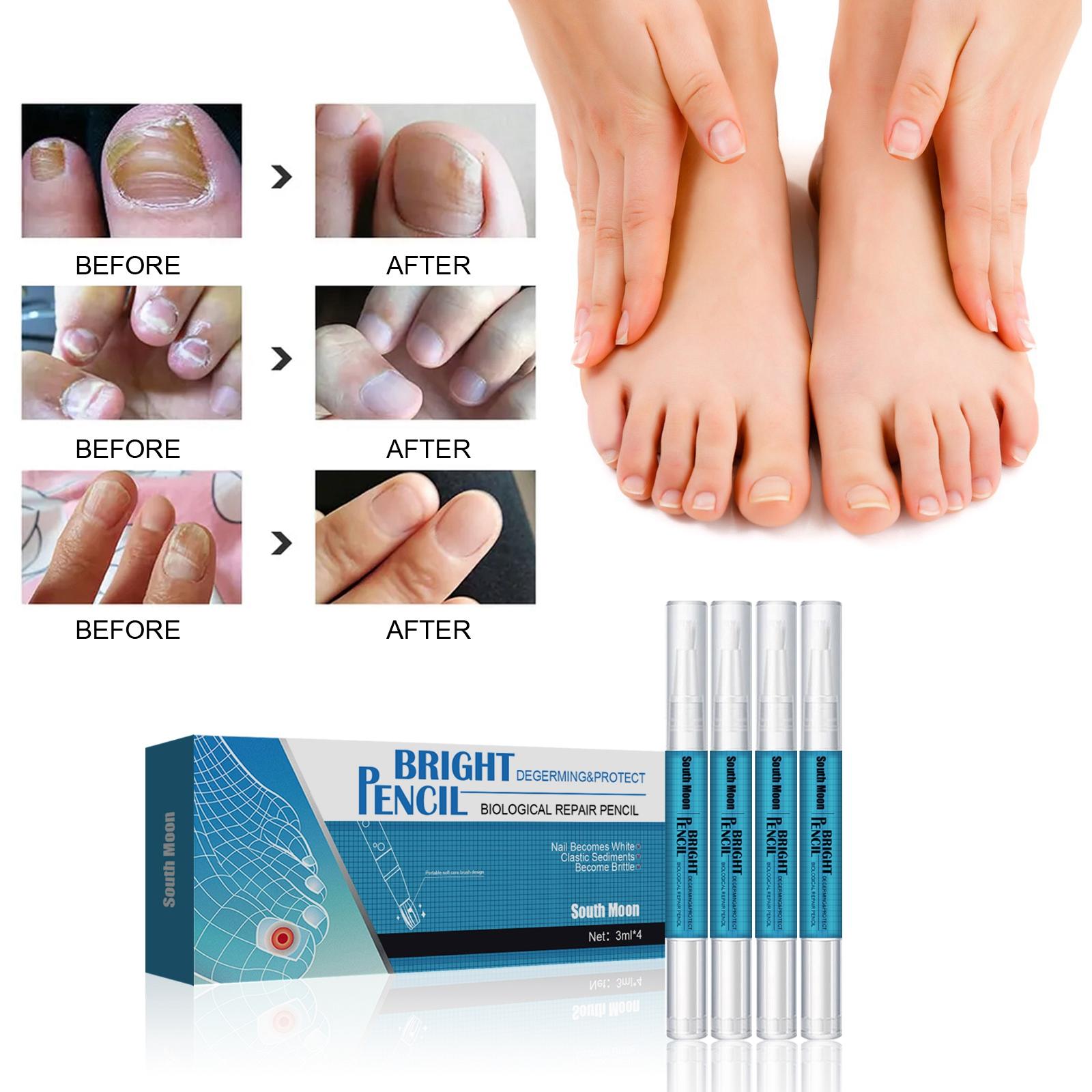4Pcs Nail Repair Liquid Pen 3ml Discoloration Foot Nail Promote Healthy Growth Remover Gentle Anti Fungal for Nail Fungus Toes