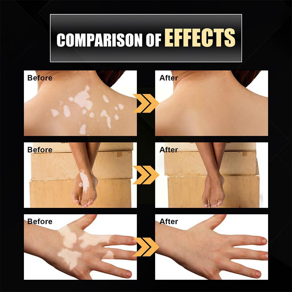 Best of 30ml Vitiligo Relief Spray Skin Moisturizing Vitiligo White Face Spray Net Repair Spot Fades Spots Vitiligo Body Repair Ski E5X2 Reviews & Tips - Image 5