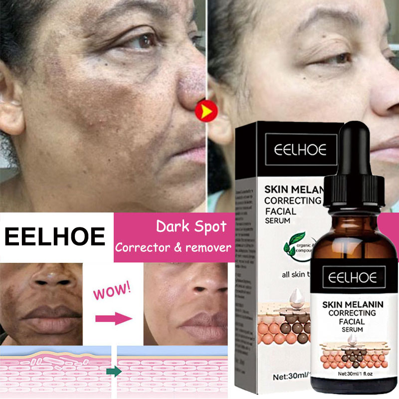 Best of Whitening Freckle Serum Fade Melasma Dark Spots Remove Pigment Brighten Lighten Melanin Improve Dull Anti-aging Face Skin Care Reviews & Tips