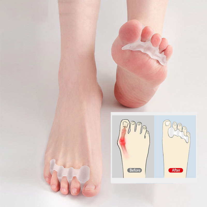 Best of 1 Pair Toe Separator Bunion Hallux Valgus Orthosis Overlapping Correctors Reviews & Tips