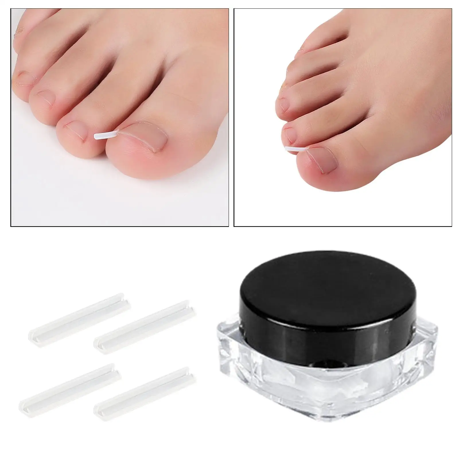 Ingrown Toenail Correction Tool Foot Toe Cleaner Glue-Free Tools Professional Toe Nail Treatment Foot Care Fingernail Protect