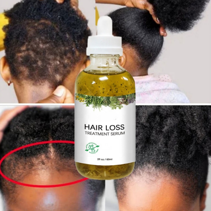 Best of Fast Hair Growth Serum African Natural Crazy Hair Regrowth Rosemary Oil Traction Alopecia Treatment Prevent Baldness Women Men Reviews & Tips - Image 3