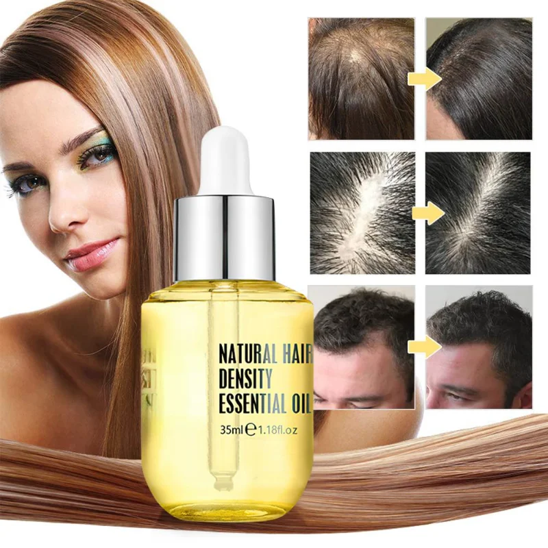 New Protect Ginger Essence Hair Growth Products Fast Regrowth Oil Serum  Prevent Loss Medicine Care Scalp Treatment Men Women| | - AliExpress