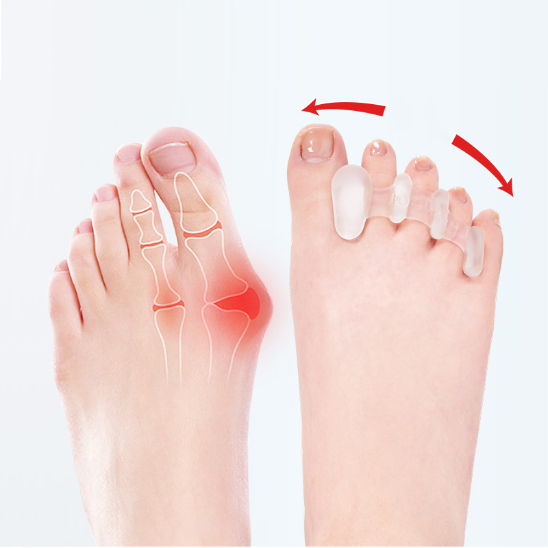 Best of Silicone Toes Separator Bunion Bone Ectropion Adjuster Toes Outer Appliance Foot Care Tools Hallux Valgus Corrector Reviews & Tips - Image 2