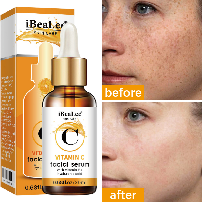 Best of Whitening Freckle Serum Vitamin C Hyaluronic Acid Dark Spot Remove Facial Serum Fade Pigmentation Melasma Brighten Skin Care Reviews & Tips