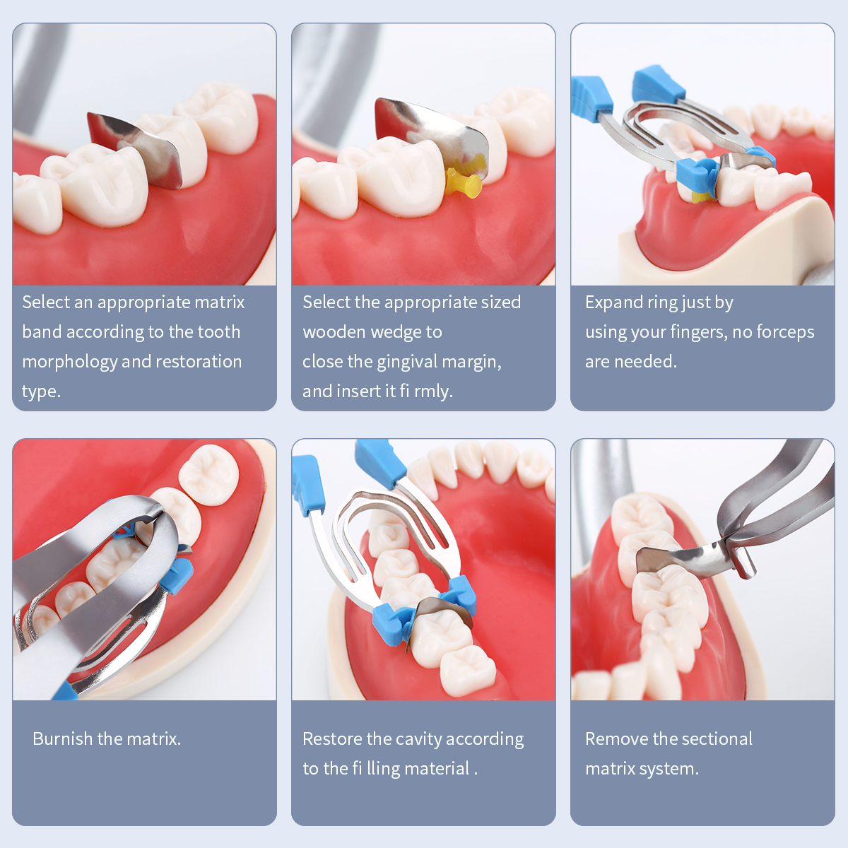 Best of AG Dental Matrix Sectional Contoured Matrices Clamps Wedges Metal Spring Clip Rings Dentist Tools Dental Lab Instrument Reviews & Tips - Image 5