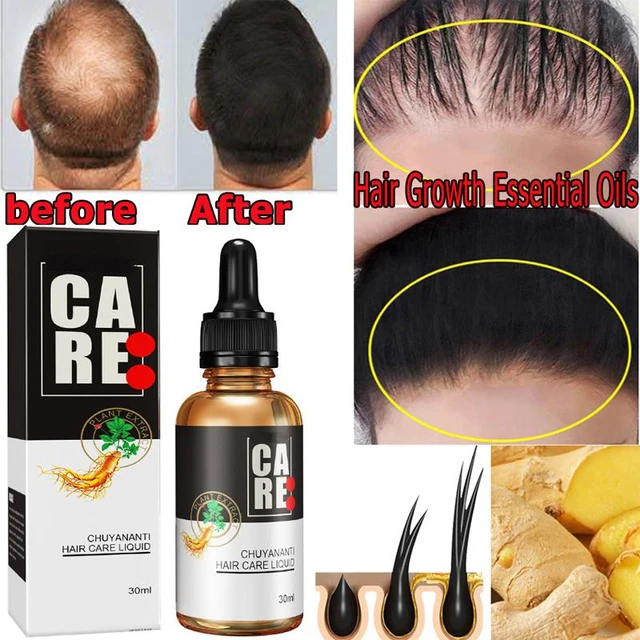 Ginger Hair Growth Products Essential Oil For Men Women Fast Regrowth Oil  Hair Scalp Treatment Anti Hair Loss Beauty Health - Hair Loss Product  Series - AliExpress