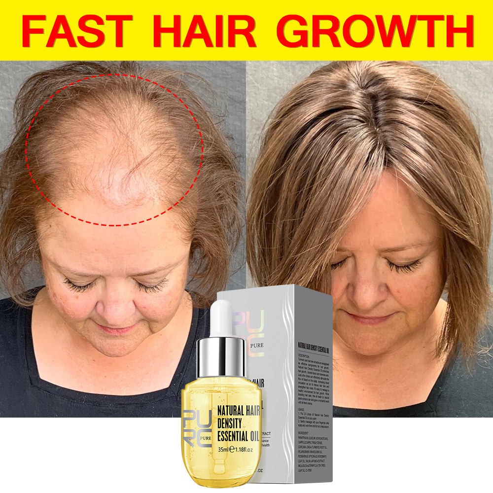 Best of PURC Fast Hair Growth For Men Women Hair Oil Care Ginger Anti Hair Loss Scalp Treatment Grow Serum Products Beauty Health 35ml Reviews & Tips