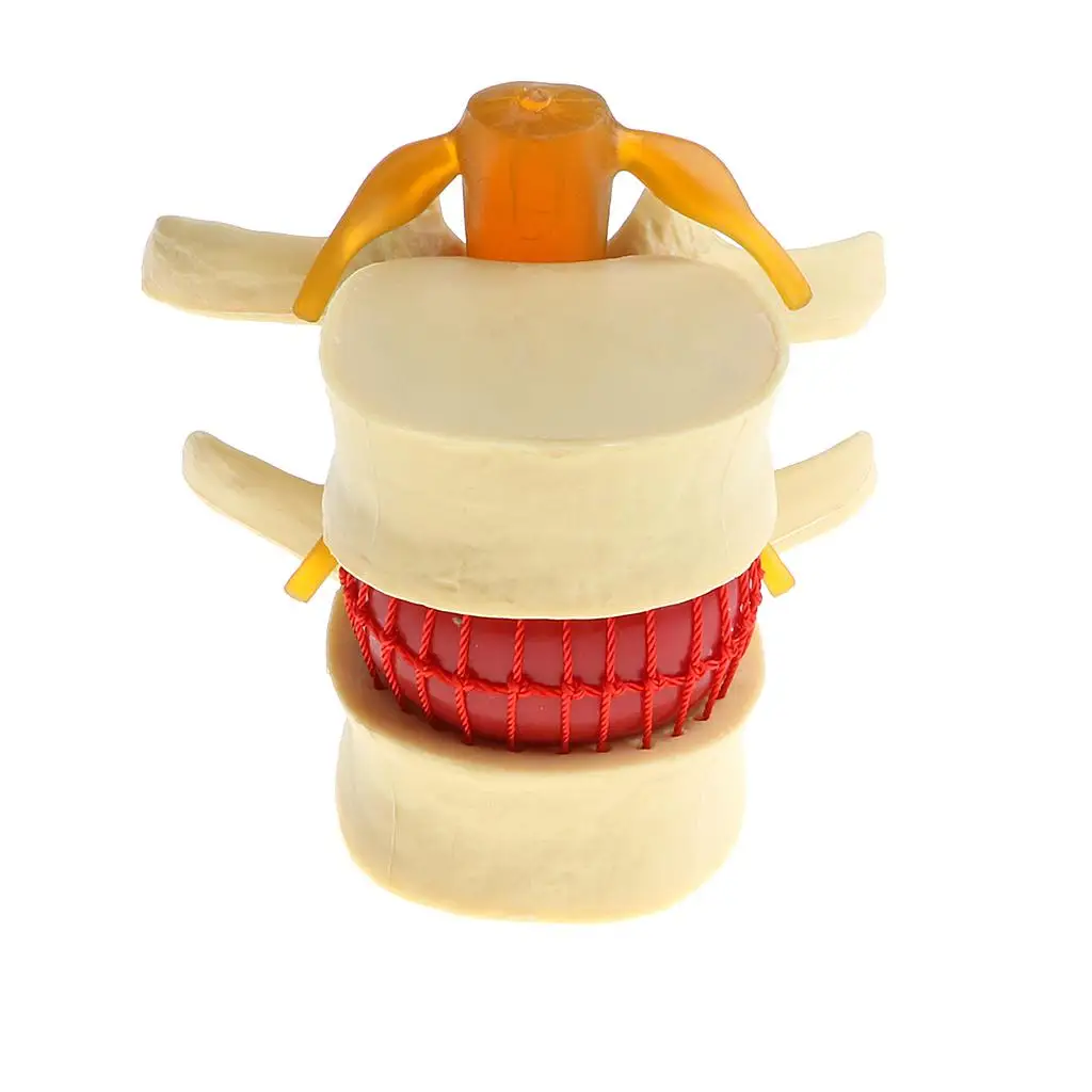  Human Spine  Vertebrae Degenerative  Disc Herniation Demonstration Model,  Teaching Tools, Magnified 2 Times