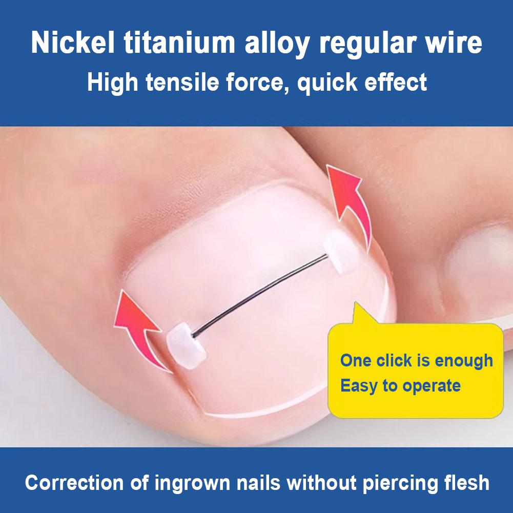 Best of Toenail Corrector Tools Pedicure Recover Embed Toe Clip Ingrown Straightening Toenail Brace Nail Professional Treatment L8M5 Reviews & Tips