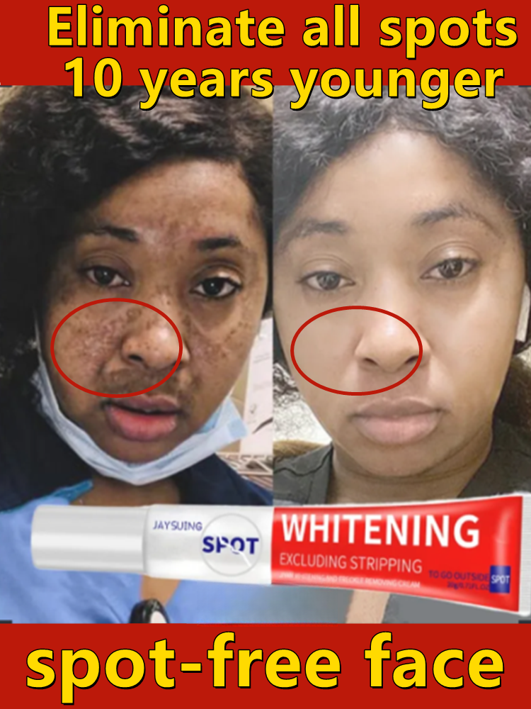 Best of Powerful Whiten Freckle Cream Fast Remove Melasma Dark Spot Fade Melanin Anti-Pigmentation Improve Dullness Brighten Skin Care Reviews & Tips