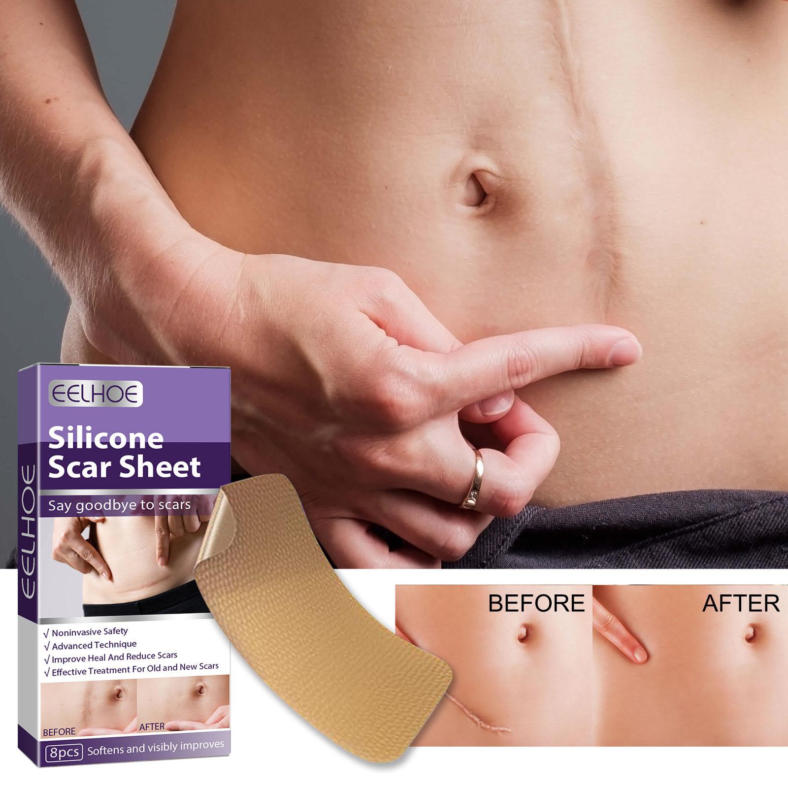 Scar Removal Silicone Scar Strips, for Burn Scars Acne Scars Keloid Scars Soft Scar Patch Comfortable Stretch Mark Reducer