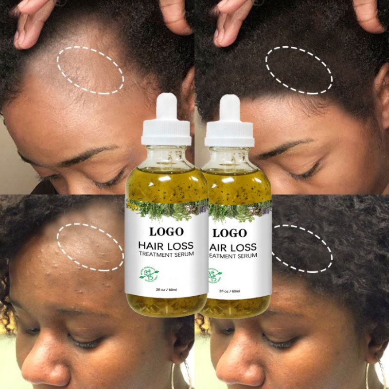 Best of Fast Hair Growth Serum African Natural Crazy Hair Regrowth Rosemary Oil Traction Alopecia Treatment Prevent Baldness Women Men Reviews & Tips - Image 2